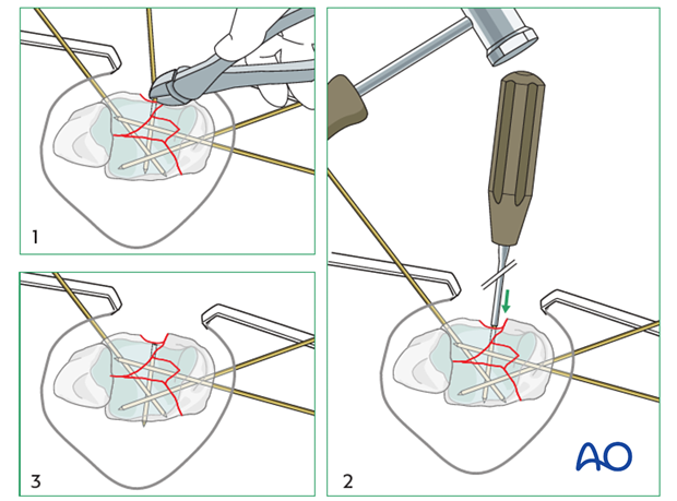 K-wire burying in a complete articular multifragmentary distal tibia fracture