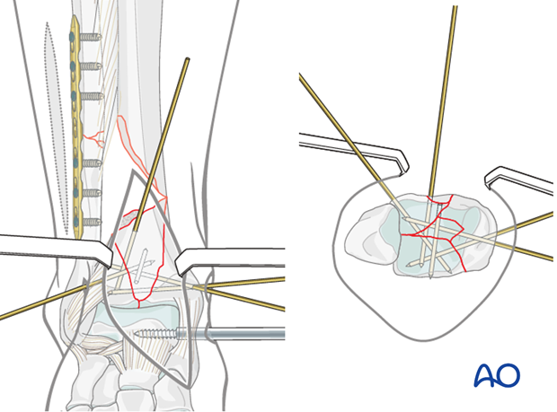 Reduction of the metaphyseal fragment in a complete articular multifragmentary distal tibia fracture