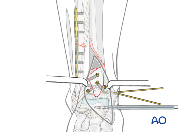 Screw fixation of the articular block in a complete articular multifragmentary distal tibia fracture