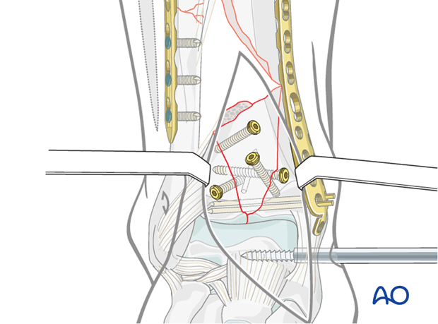 Plate insertion to fix a complete articular multifragmentary distal tibia fracture