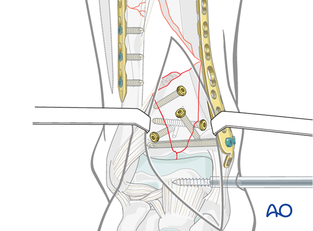 Definitive stabilization of the articular block to fix a complete articular multifragmentary distal tibia fracture