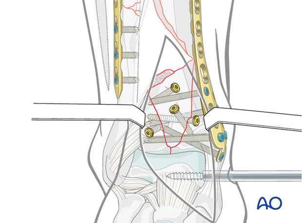 Metaphyseal fixation in a complete articular multifragmentary distal tibia fracture