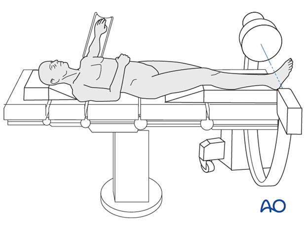 temporary joint bridging modular external fixation