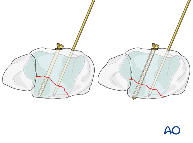 lag screw principles