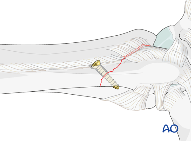 lag screw principles