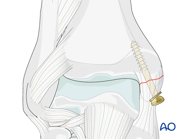 lag screw principles