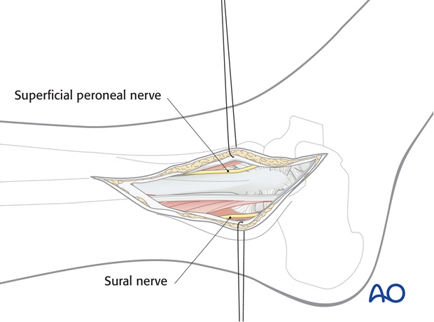 lateral approach