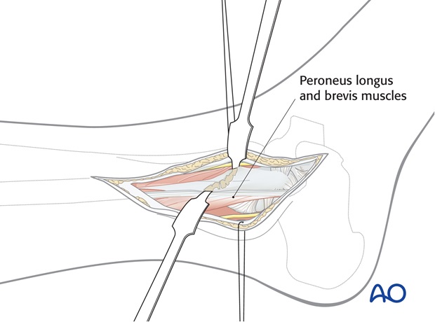 lateral approach