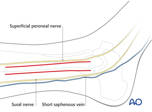 lateral approach for high fibular fractures