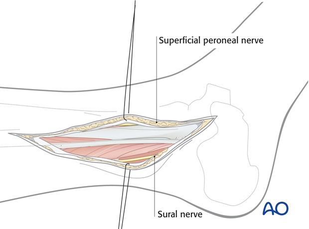 lateral approach for high fibular fractures