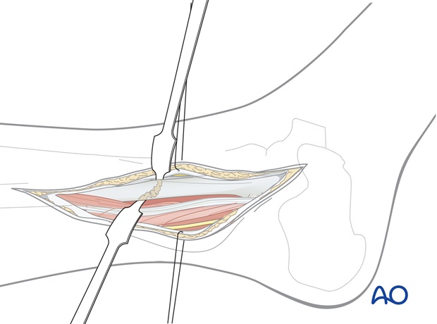 lateral approach for high fibular fractures