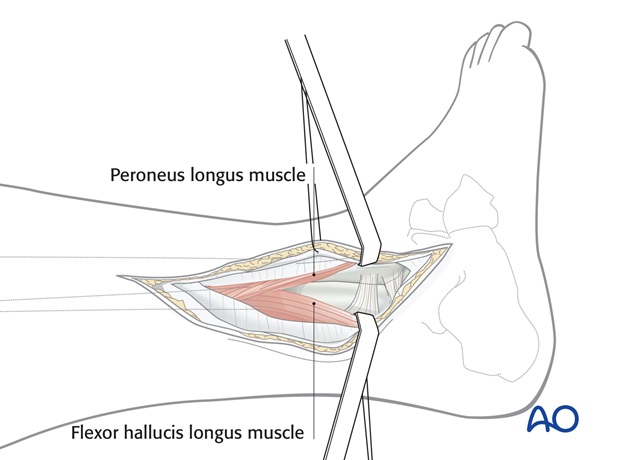 lateral approach for high fibular fractures