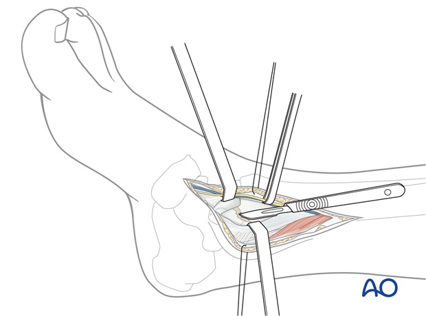 medial approach anterior