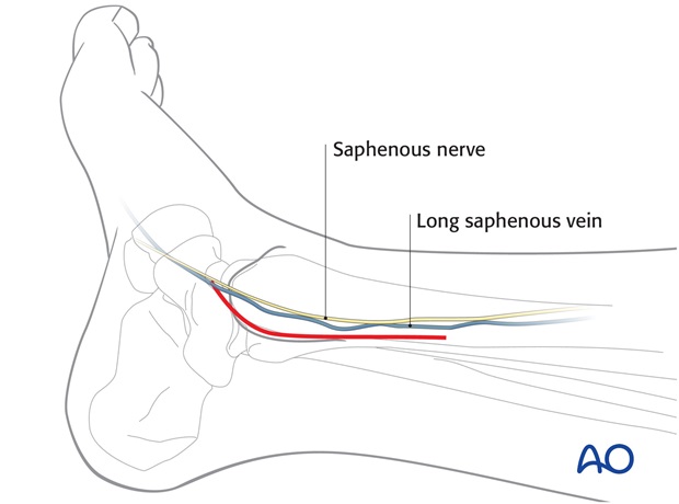 posteromedial approach