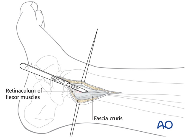 posteromedial approach