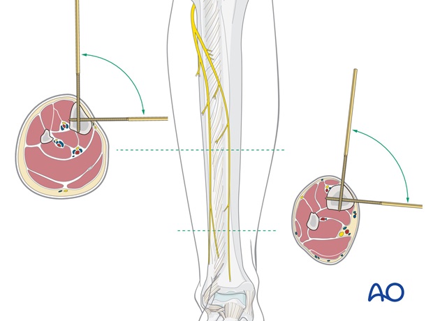 safe zones for percutaneous instrumentation