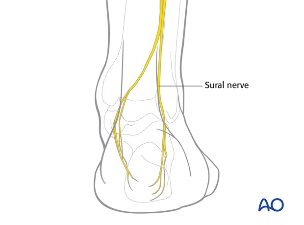 posterolateral approach to the volkmann fragment