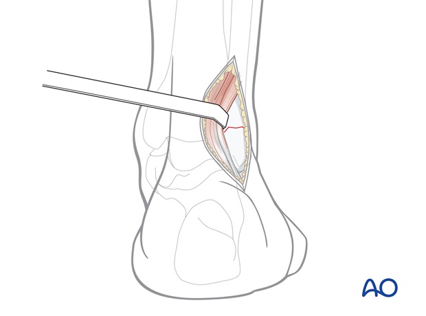 posterolateral approach to the volkmann fragment