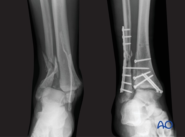 fibula multifragmentary c fracture lateral bridging plate