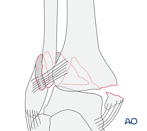 Simple, with fracture of the medial malleolus (AO/OTA 44B3.2)