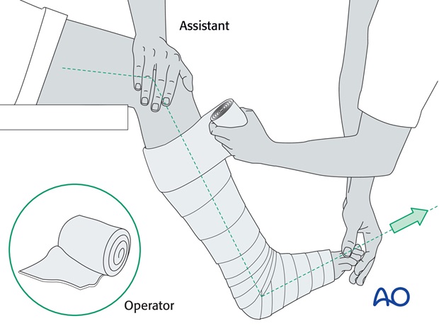 long leg circular cast