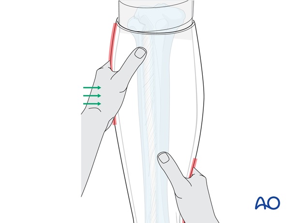 long leg circular cast