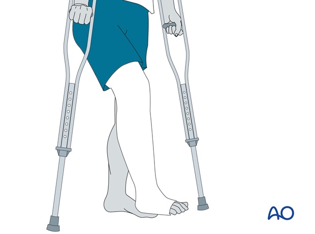 suprasyndesmotic multifragmentary fibula medial injury posterior fracture