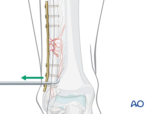 fibula multifragmentary c fracture lateral bridging plate