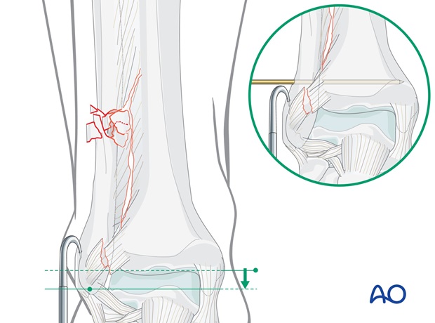 fibula multifragmentary c fracture lateral bridging plate