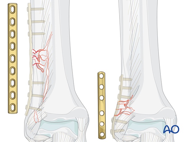 fibula multifragmentary fracture lateral bridging plate