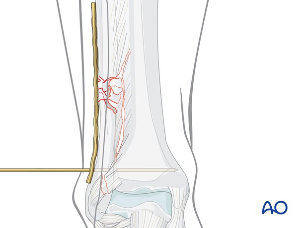 fibula multifragmentary c fracture lateral bridging plate