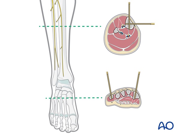 triangular external fixation