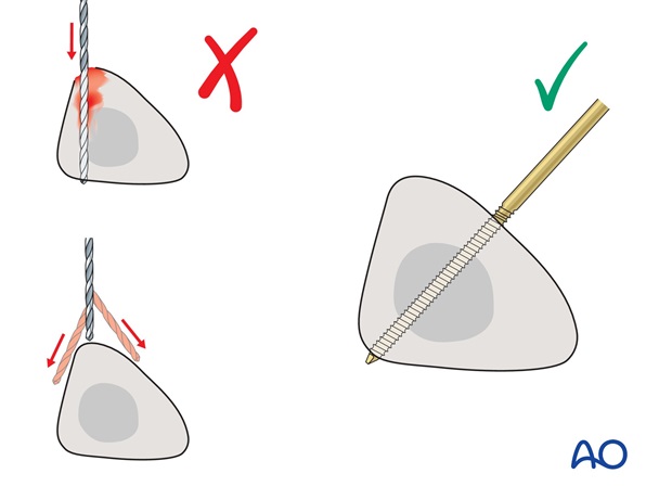 triangular external fixation