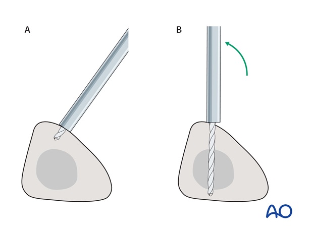 triangular external fixation