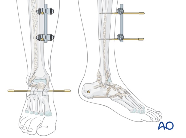 triangular external fixation