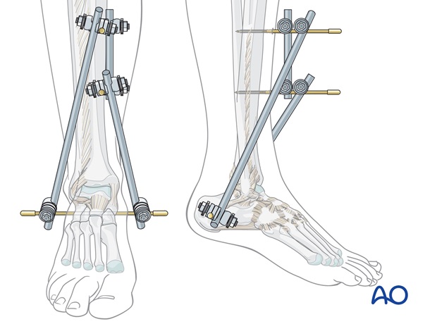 triangular external fixation