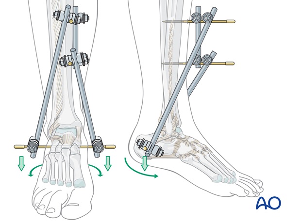 triangular external fixation