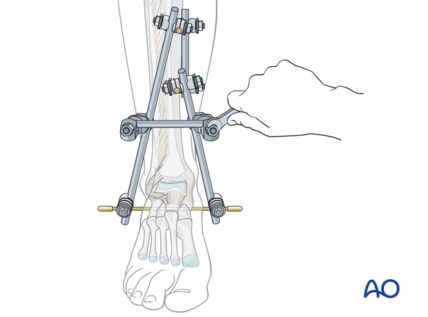 triangular external fixation