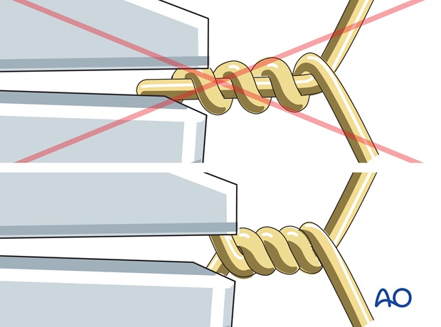 tension band wiring