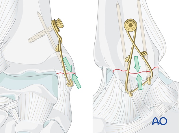 medial transverse fracture tension band wiring