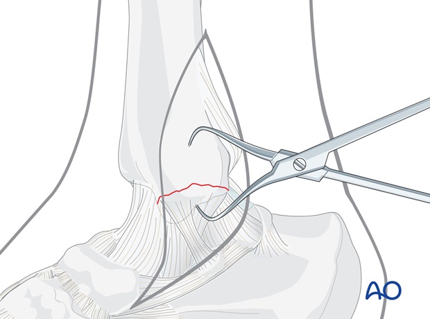 medial transverse fracture tension band wiring