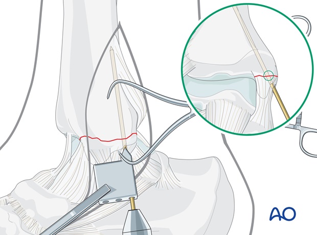 medial transverse fracture tension band wiring