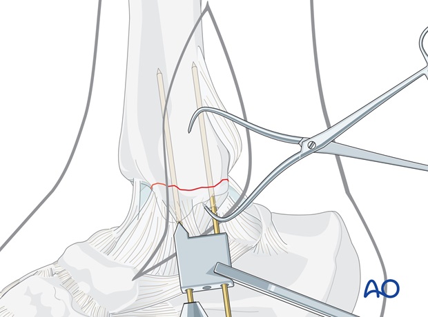 medial transverse fracture tension band wiring