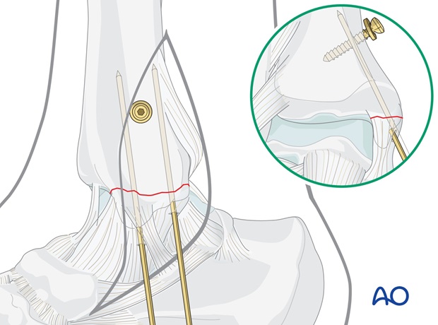 medial transverse fracture tension band wiring