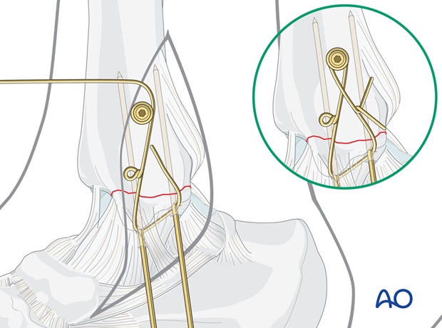 medial transverse fracture tension band wiring