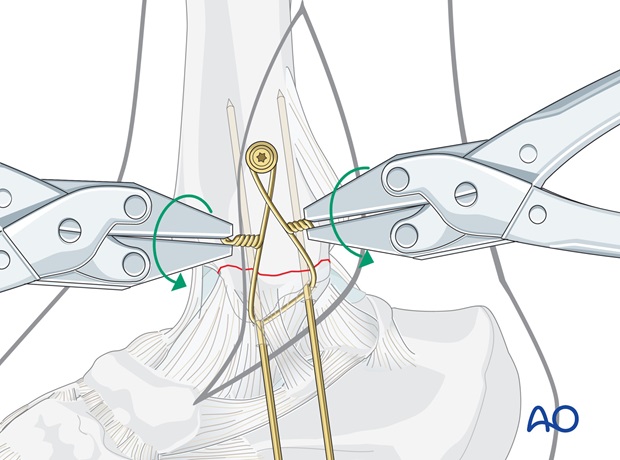 medial transverse fracture tension band wiring