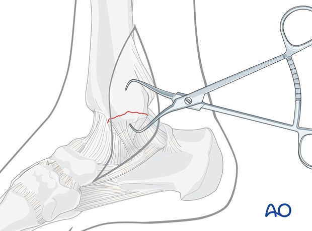 lag screws transverse fracture