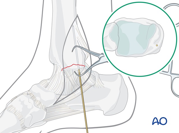 lag screws transverse fracture