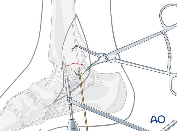 lag screws transverse fracture