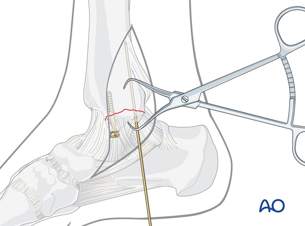 lag screws transverse fracture